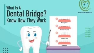 What Is A Dental Bridge and Know How They Work