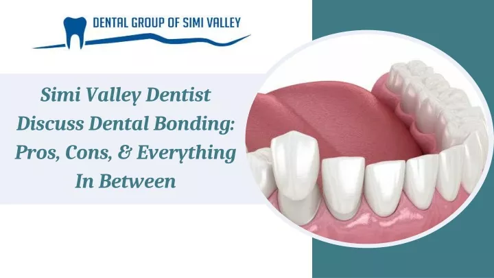 simi valley dentist discuss dental bonding pros