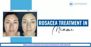 Get the Comprehensive Solutions for Rosacea Treatment in Miami with Us.