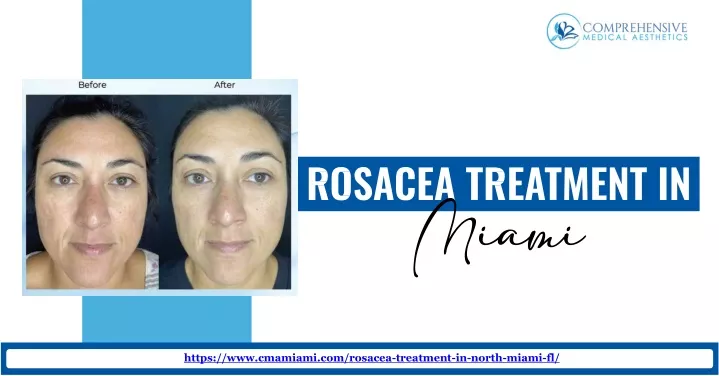 https www cmamiami com rosacea treatment in north