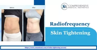 Get the best Radiofrequency Skin Tightening at Comprehensive Medical Aesthetics