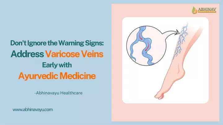 don t ignore the warning signs address varicose