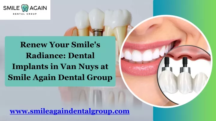renew your smile s radiance dental implants