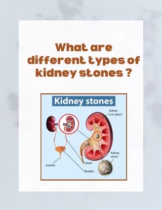 What are different types of kidney stones ?