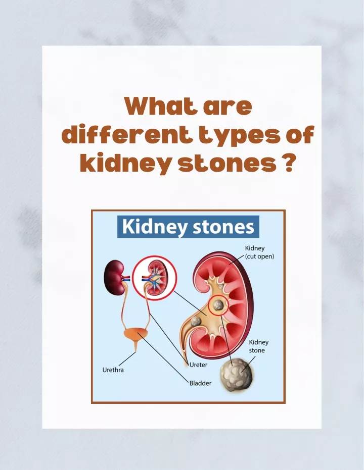 what are different types of kidney stones