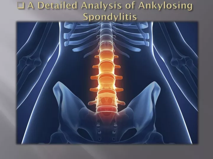 a detailed analysis of ankylosing spondylitis
