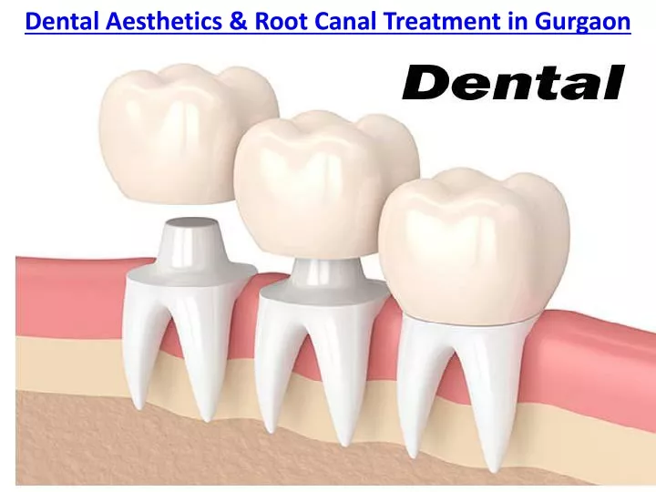 dental aesthetics root canal treatment in gurgaon