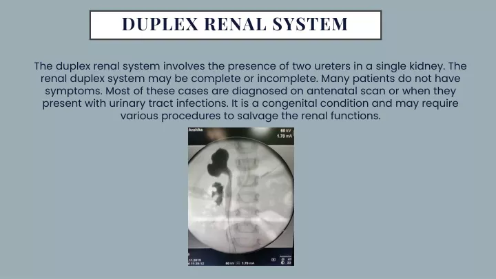 duplex renal system