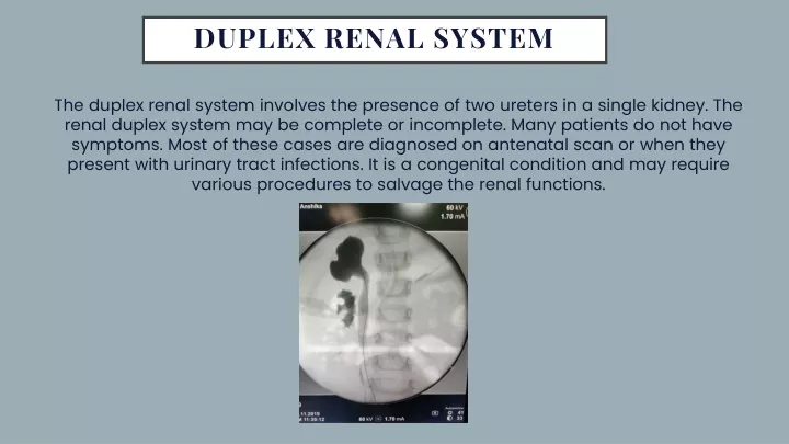 PPT - Duplex Renal System PowerPoint Presentation, free download - ID ...