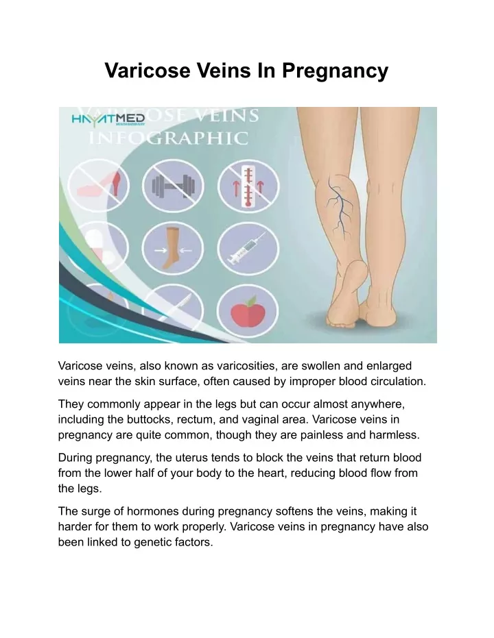 varicose veins in pregnancy