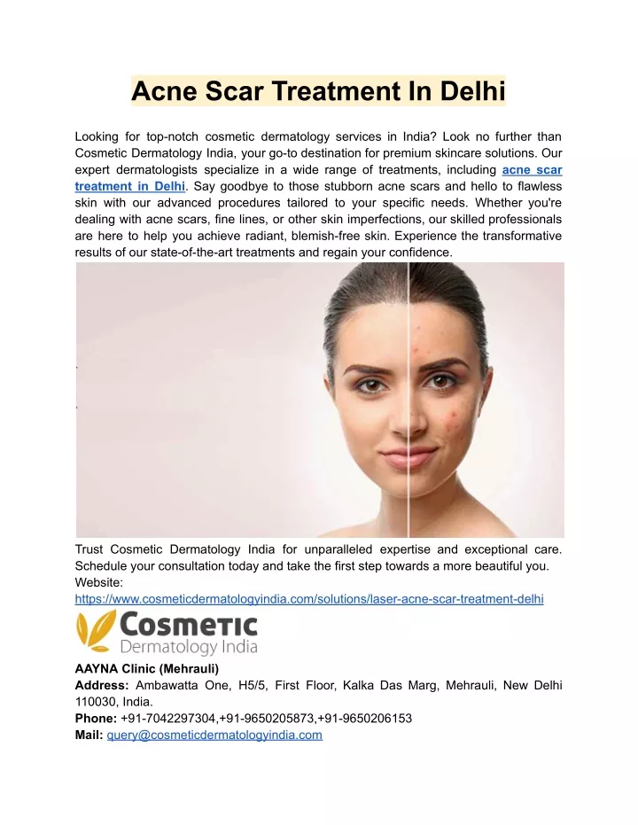 acne scar treatment in delhi