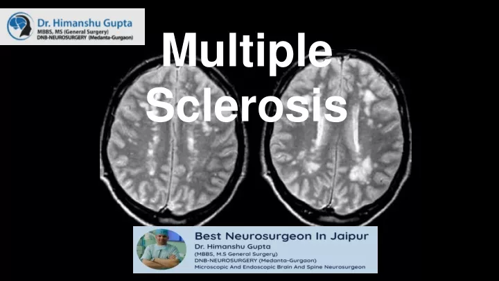 multiple sclerosis