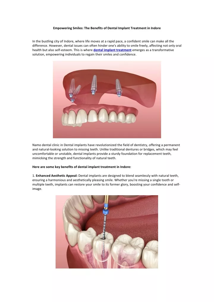 empowering smiles the benefits of dental implant