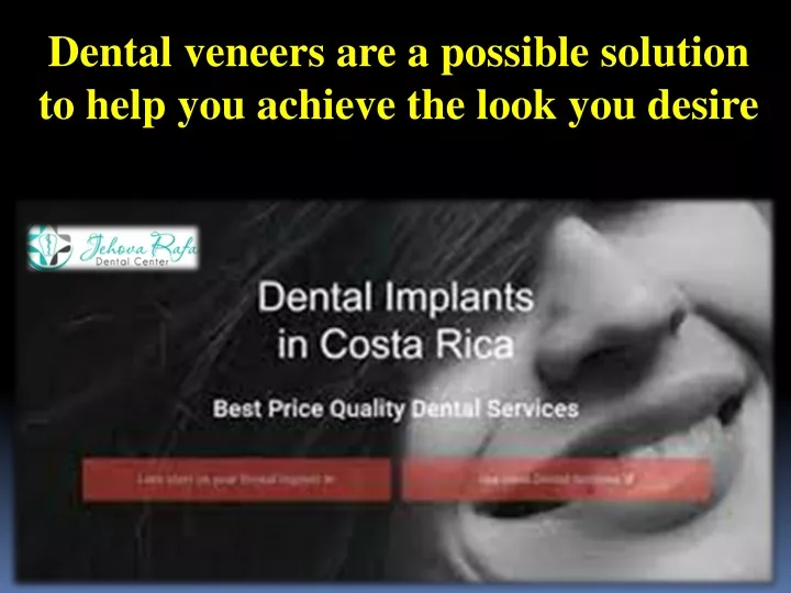 dental veneers are a possible solution to help