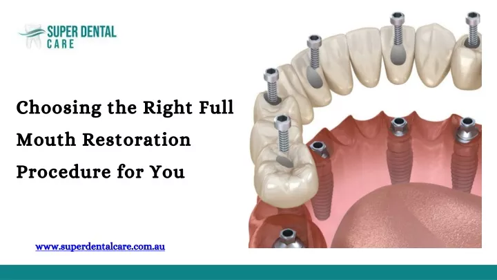 choosing the right full mouth restoration