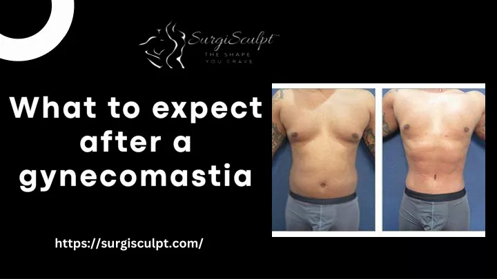 what to expect after a gynecomastia