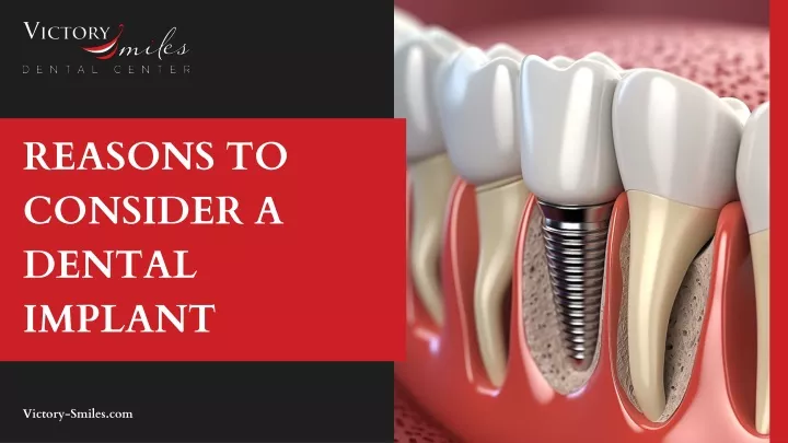 reasons to consider a dental implant