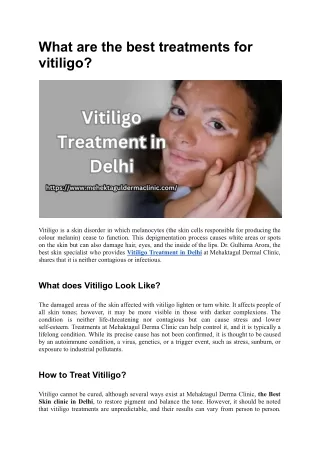 Vitiligo Treatment in Delhi