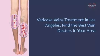 Varicose Veins Treatment in Los Angeles: Find the Best Vein Doctors in Your Area