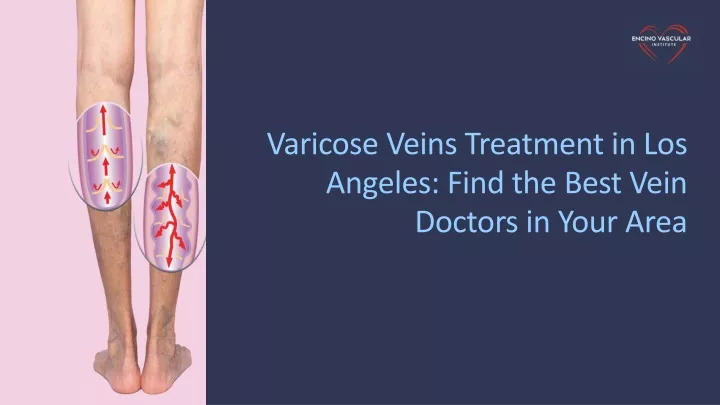 varicose veins treatment in los angeles find