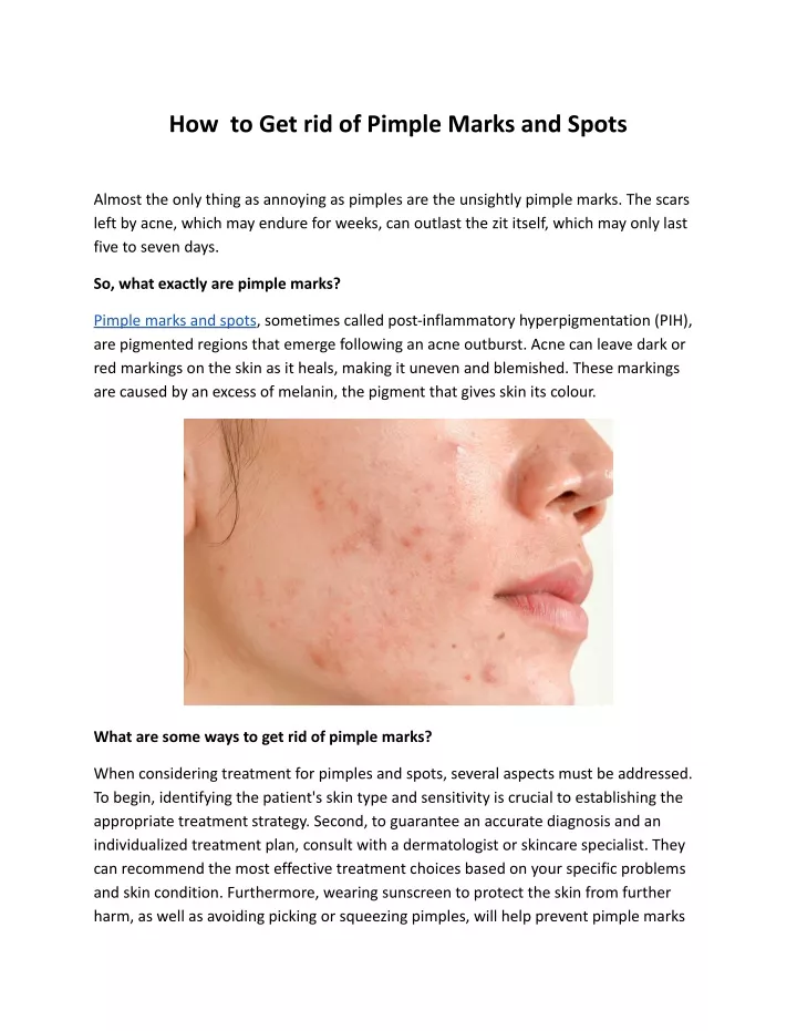 how to get rid of pimple marks and spots