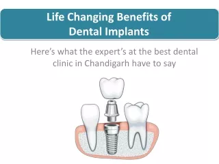 Life Changing Benefits of Dental Implants | Lifecare Dental Clinic