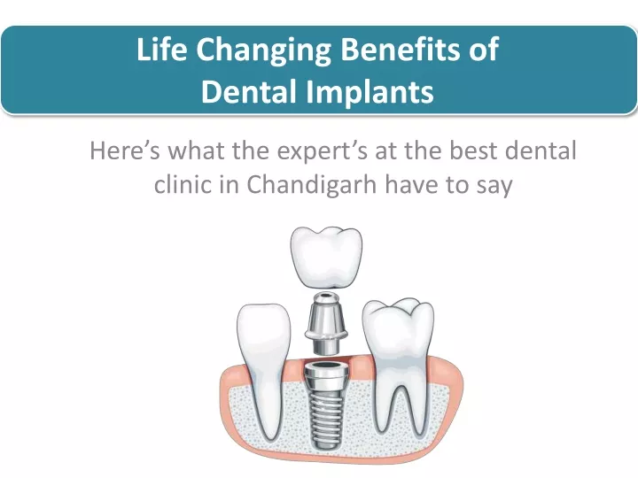 life changing benefits of dental implants