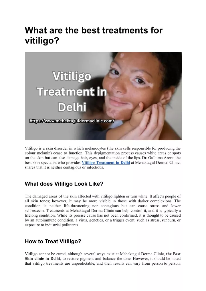 what are the best treatments for vitiligo