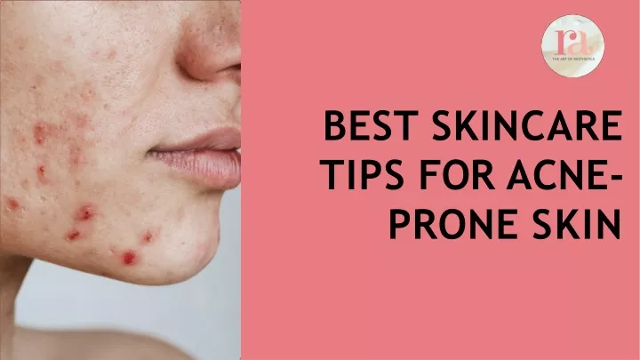 best skincare tips for acne prone skin
