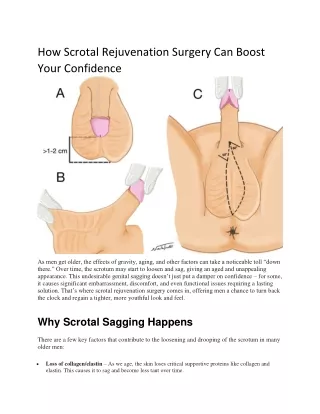 How Scrotal Rejuvenation Surgery Can Boost Your Confidence