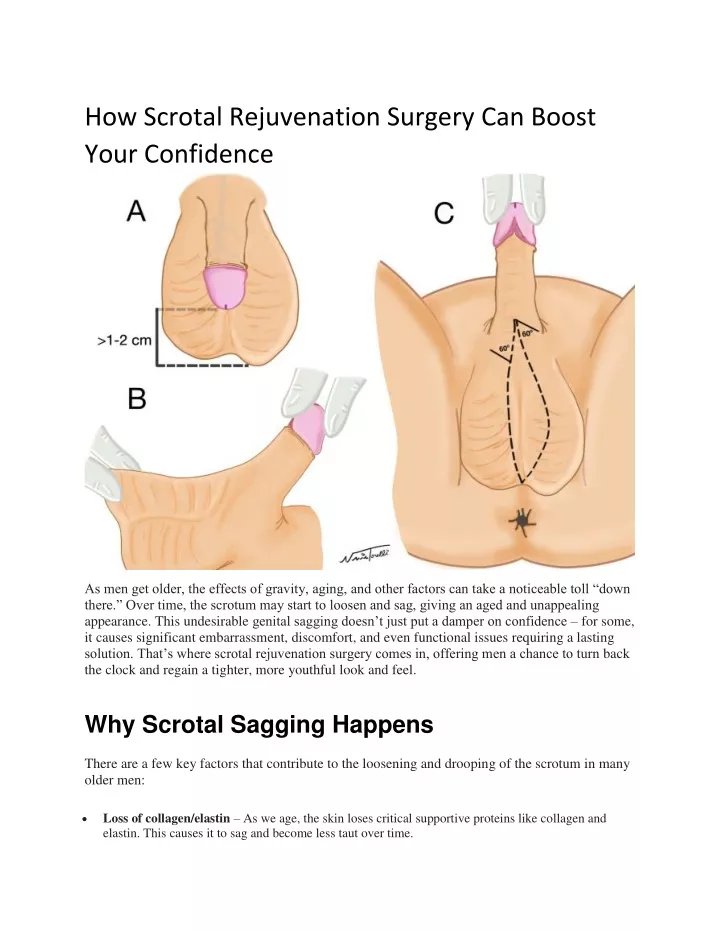 how scrotal rejuvenation surgery can boost your