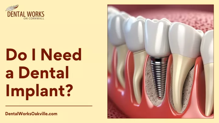 do i need a dental implant