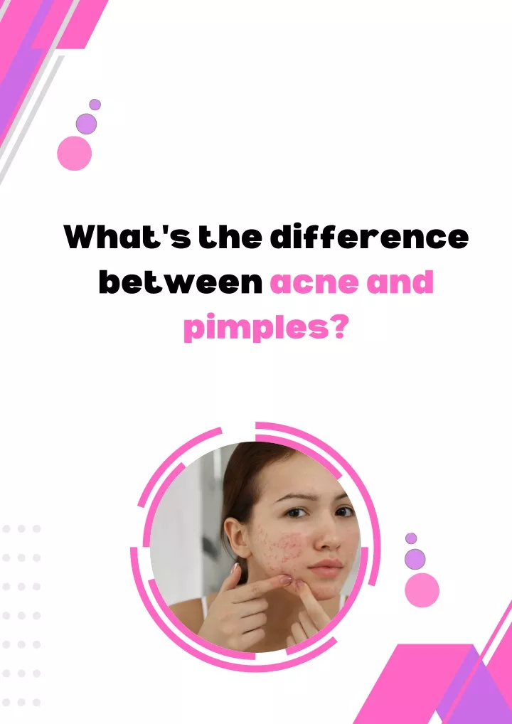 what s the difference between acne and pimples