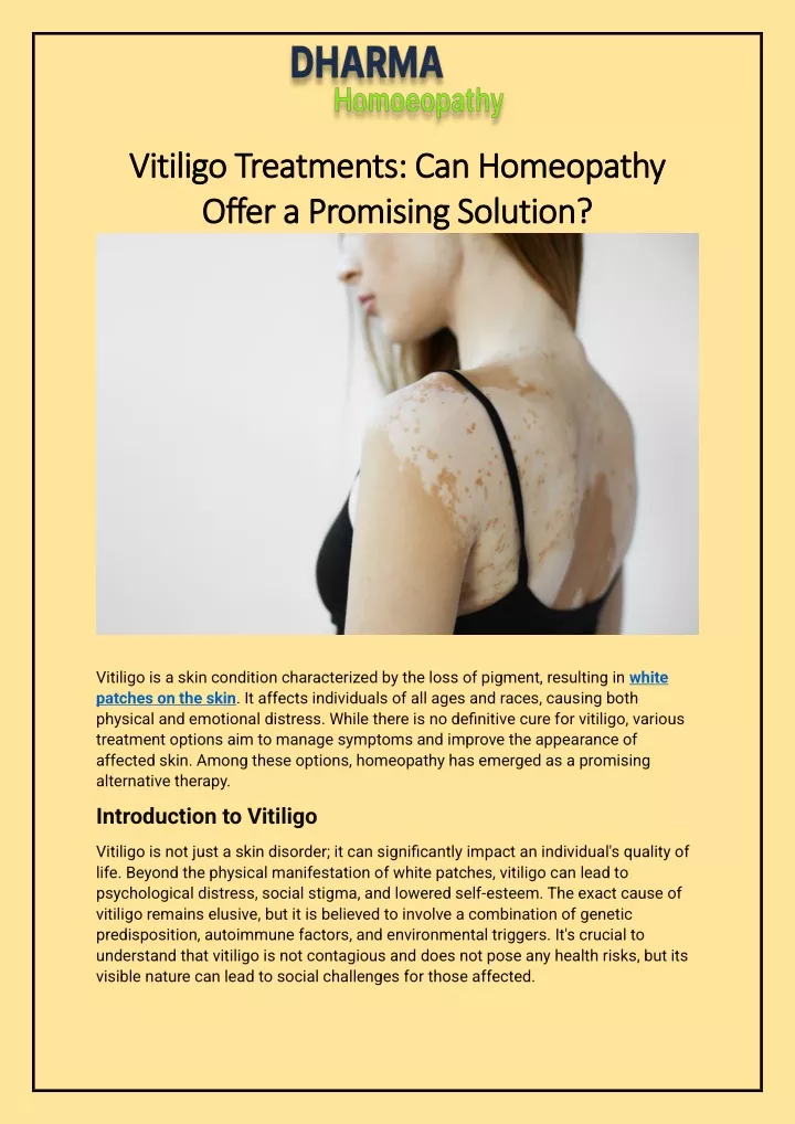 vitiligo treatments can homeopathy vitiligo