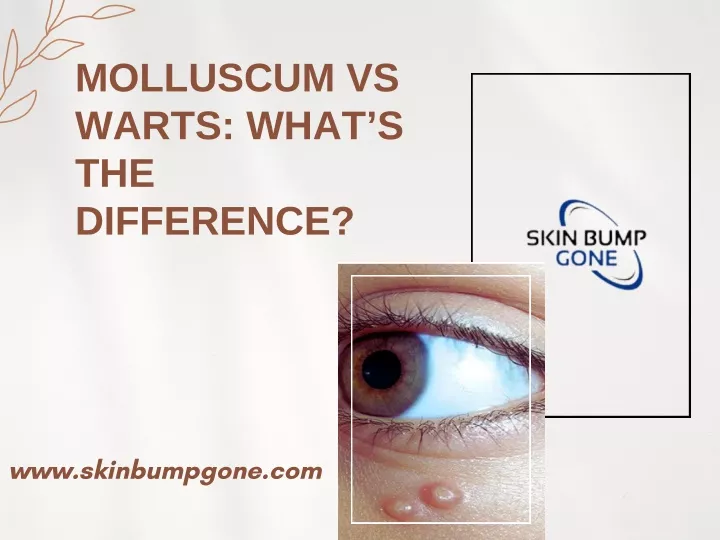 molluscum vs warts what s the difference