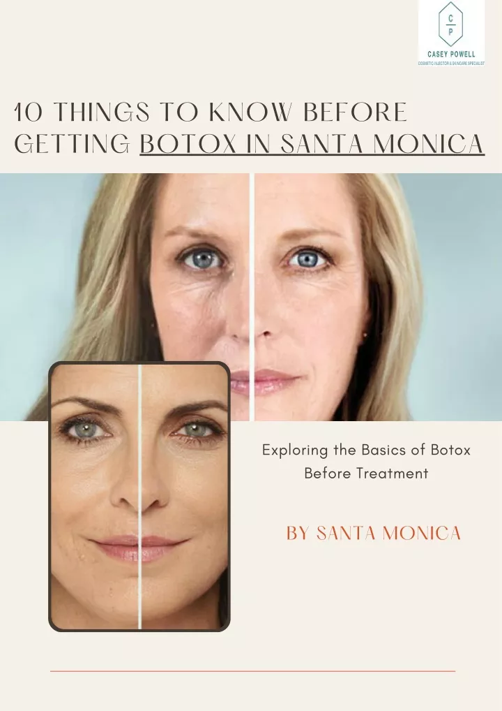 10 things to know before getting botox in santa