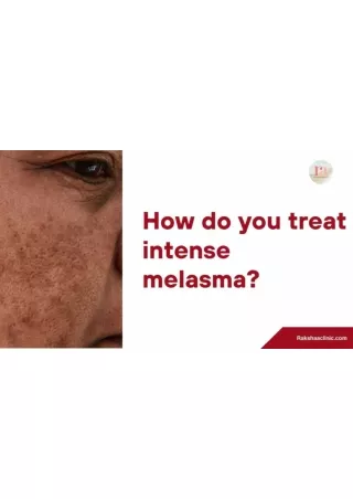 How do you treat intense melasma?