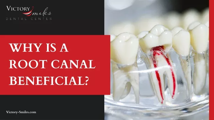 why is a root canal beneficial
