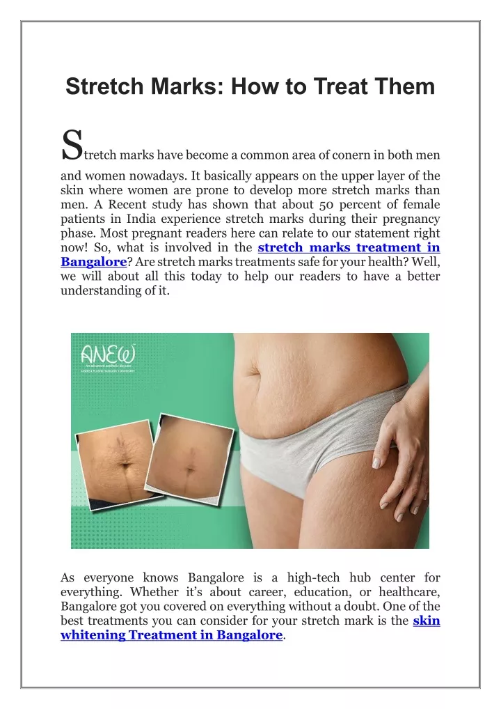 stretch marks how to treat them