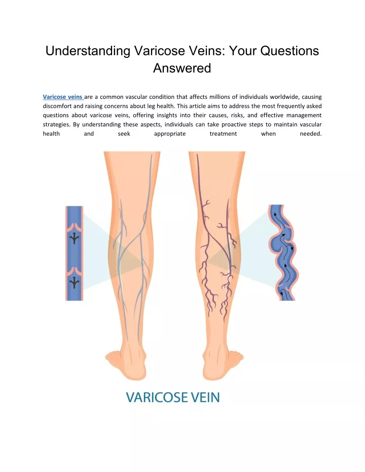 understanding varicose veins your questions