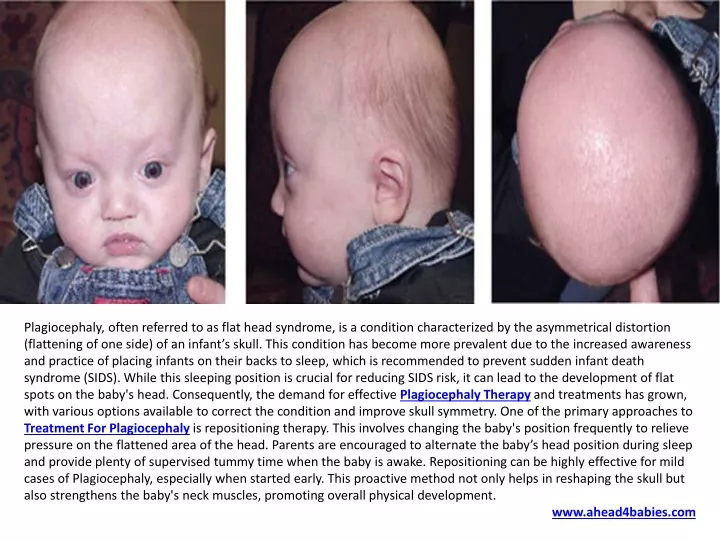 plagiocephaly often referred to as flat head