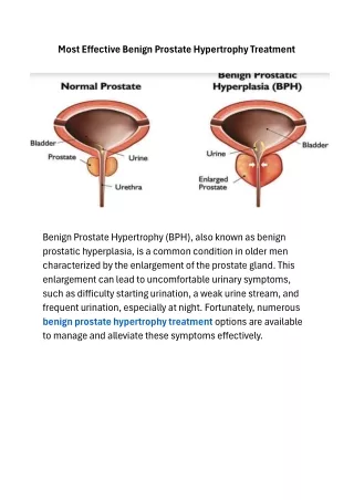 Most Effective Benign Prostate Hypertrophy Treatment
