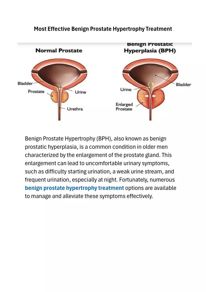 most effective benign prostate hypertrophy