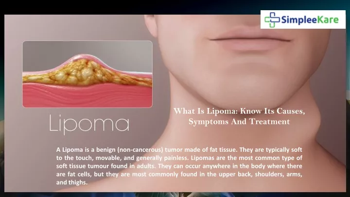 what is lipoma know its causes symptoms