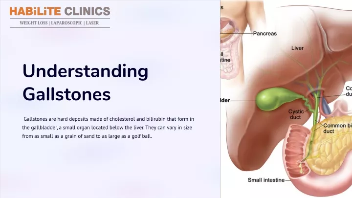 understanding gallstones