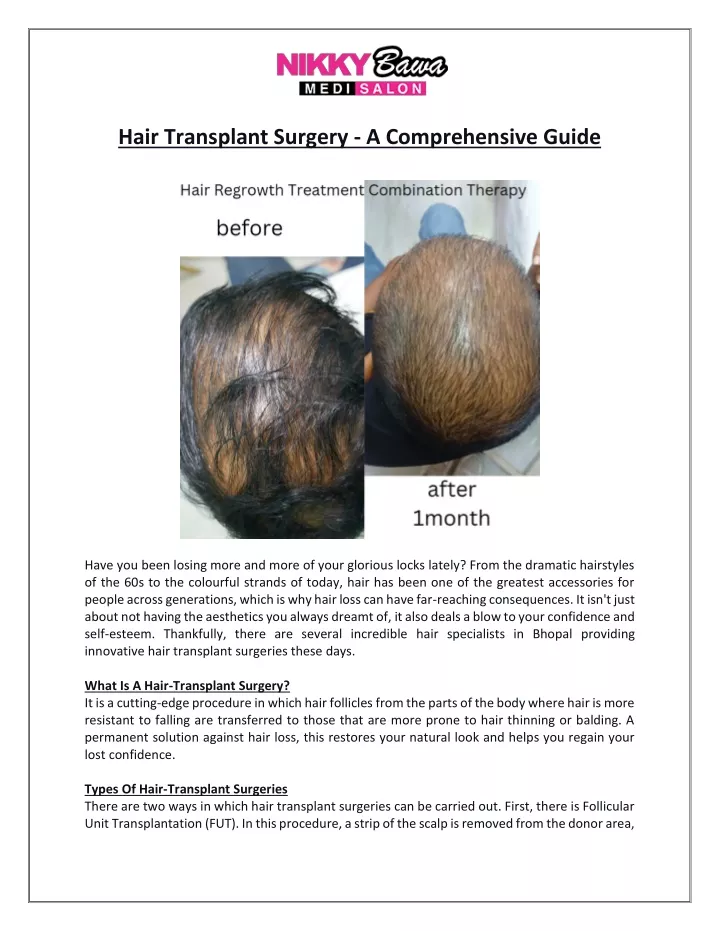 hair transplant surgery a comprehensive guide