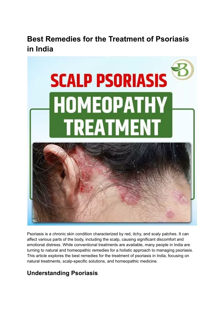 best remedies for the treatment of psoriasis