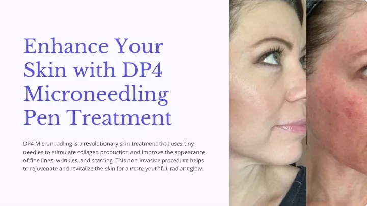 PPT - Enhance Your Skin with DP4 Microneedling Pen Treatment PowerPoint ...