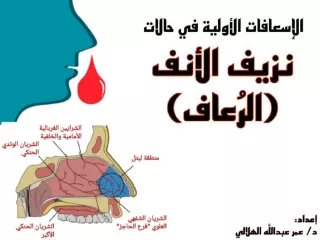 الإسعافات الأولية في حالة نزيف الأنف (الرعاف)