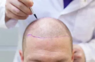 irvin hair treatment in gurgaon